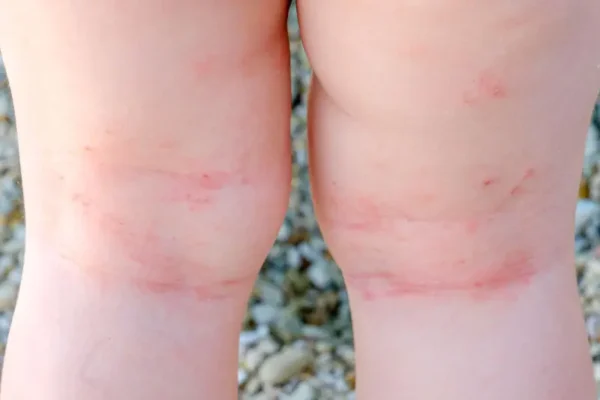 Hard water skin problems - effects of limescale on skin